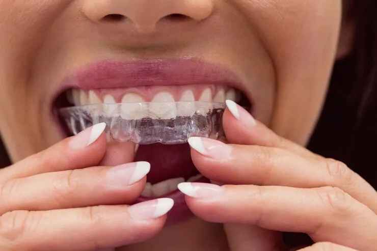 Invisalign mundi clinic