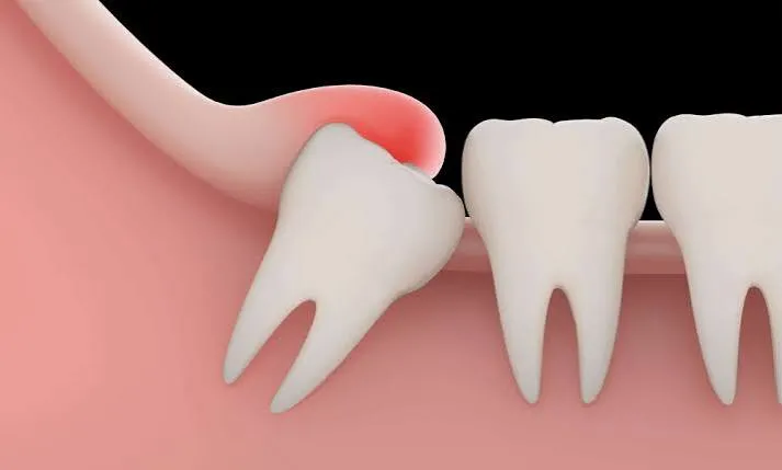 dente incluso